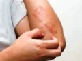 5 Cara Memilih Salep Gatal yang Tepat Sesuai Kebutuhan