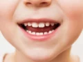 6 Tips Merawat Gigi Anak yang Baru Tumbuh agar Sehat Selalu