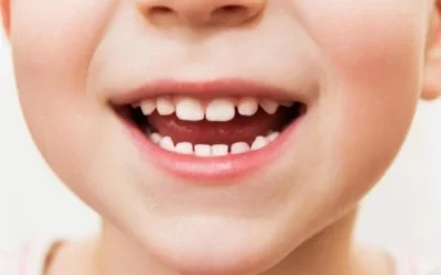 6 Tips Merawat Gigi Anak yang Baru Tumbuh agar Sehat Selalu