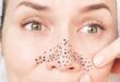 Ketahui Cara Menghilangkan Komedo Hitam di Hidung dengan Bahan Alami