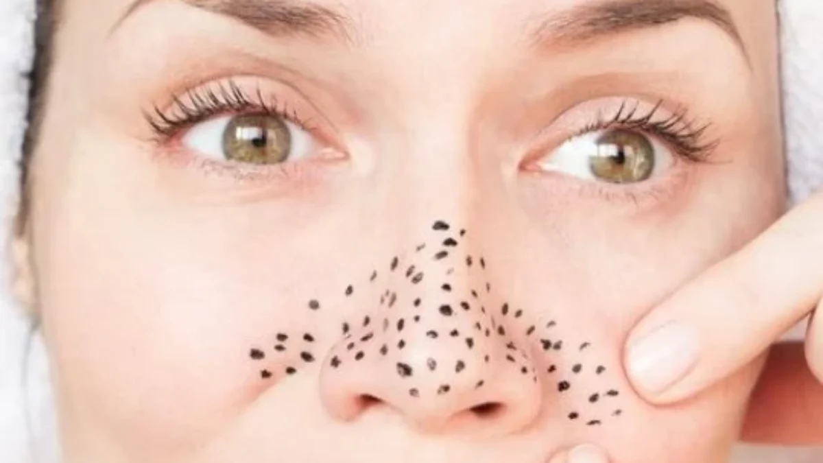 Ketahui Cara Menghilangkan Komedo Hitam di Hidung dengan Bahan Alami