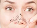 Ketahui Cara Menghilangkan Komedo Hitam di Hidung dengan Bahan Alami