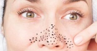 Ketahui Cara Menghilangkan Komedo Hitam di Hidung dengan Bahan Alami