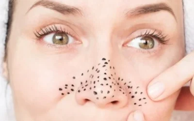 Ketahui Cara Menghilangkan Komedo Hitam di Hidung dengan Bahan Alami