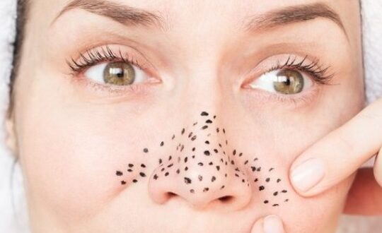 Ketahui Cara Menghilangkan Komedo Hitam di Hidung dengan Bahan Alami