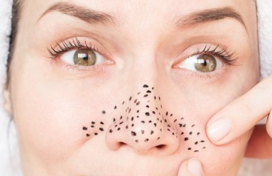 Ketahui Cara Menghilangkan Komedo Hitam di Hidung dengan Bahan Alami