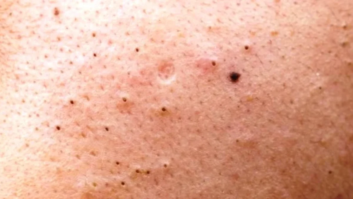 Ketahui Cara Menghilangkan Komedo Hitam dengan Mudah dan Efektif