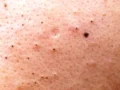 Ketahui Cara Menghilangkan Komedo Hitam dengan Mudah dan Efektif