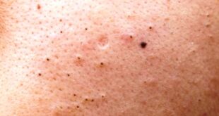 Ketahui Cara Menghilangkan Komedo Hitam dengan Mudah dan Efektif
