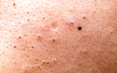 Ketahui Cara Menghilangkan Komedo Hitam dengan Mudah dan Efektif